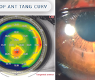 Therapeutic Refractive Surgery for Keratoconus