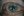 Figure 2. Poor pupillary dilation related to PXF syndrome.