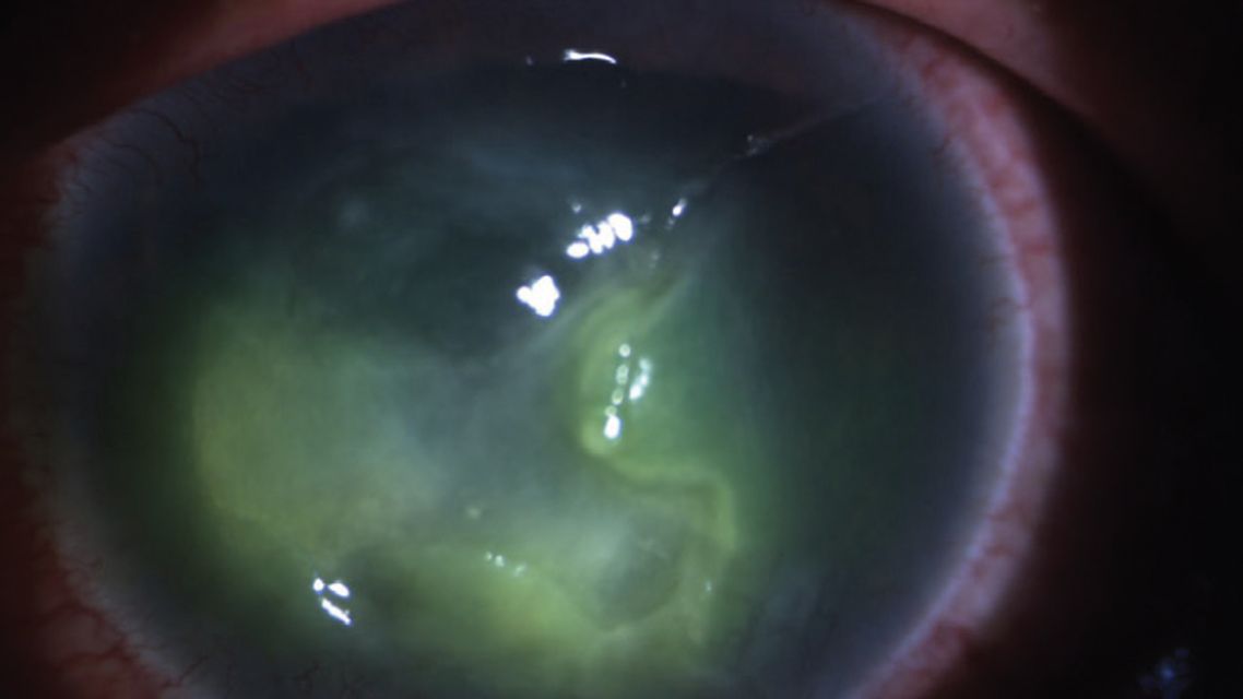 When the Eye Gets Meta Advanced Neurotrophic Keratopathy Secondary to Recurrent Herpes Simplex Keratitis
