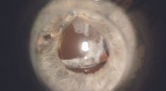 IOL Dislocation After Penetrating Keratoplasty