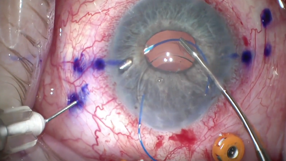 Sutureless Scleral Fixation of IOLS