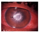 A Rare Case of Pythium Keratitis Masquerading as Fungal Keratitis