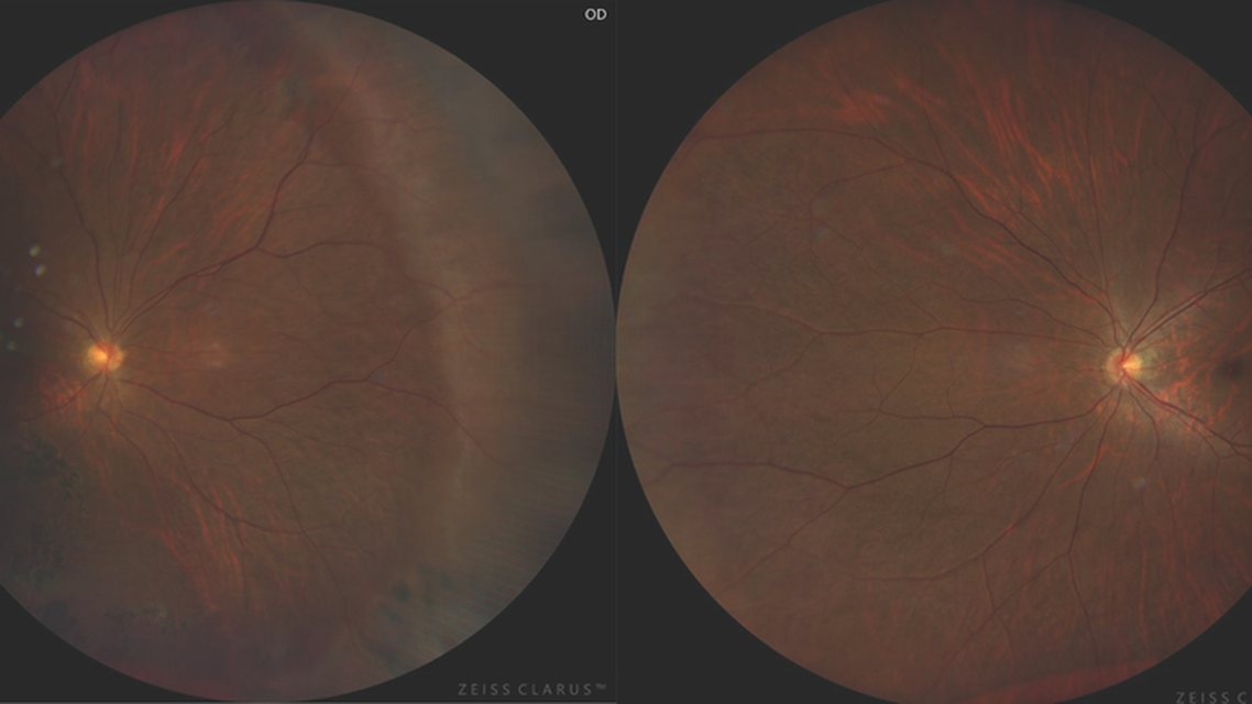 Cataract Surgery in Eyes With Retinal Pathology
