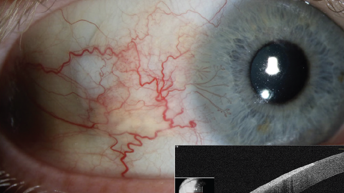 Ocular Surface Squamous Neoplasia in an Avid Sailor With Poor Compliance to Sun Protective Measures