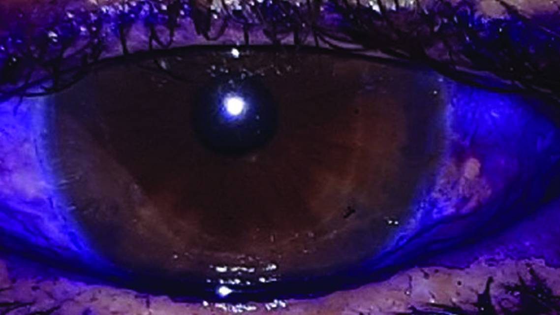 Dye Enhanced Laser Conjunctivoplasty for Conjunctivochalasis