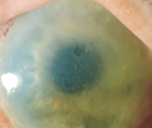 Origins Hero image showing diffuse limbus to limbus corneal edema