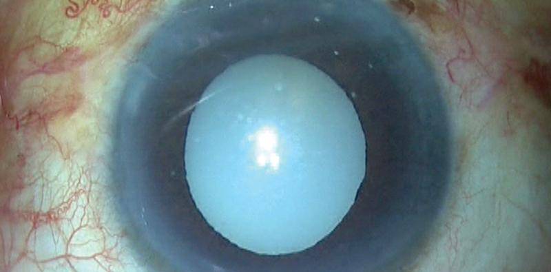 Morgagnian Cataract Presents Technical Challenges