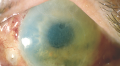 Origins Hero image showing diffuse limbus to limbus corneal edema