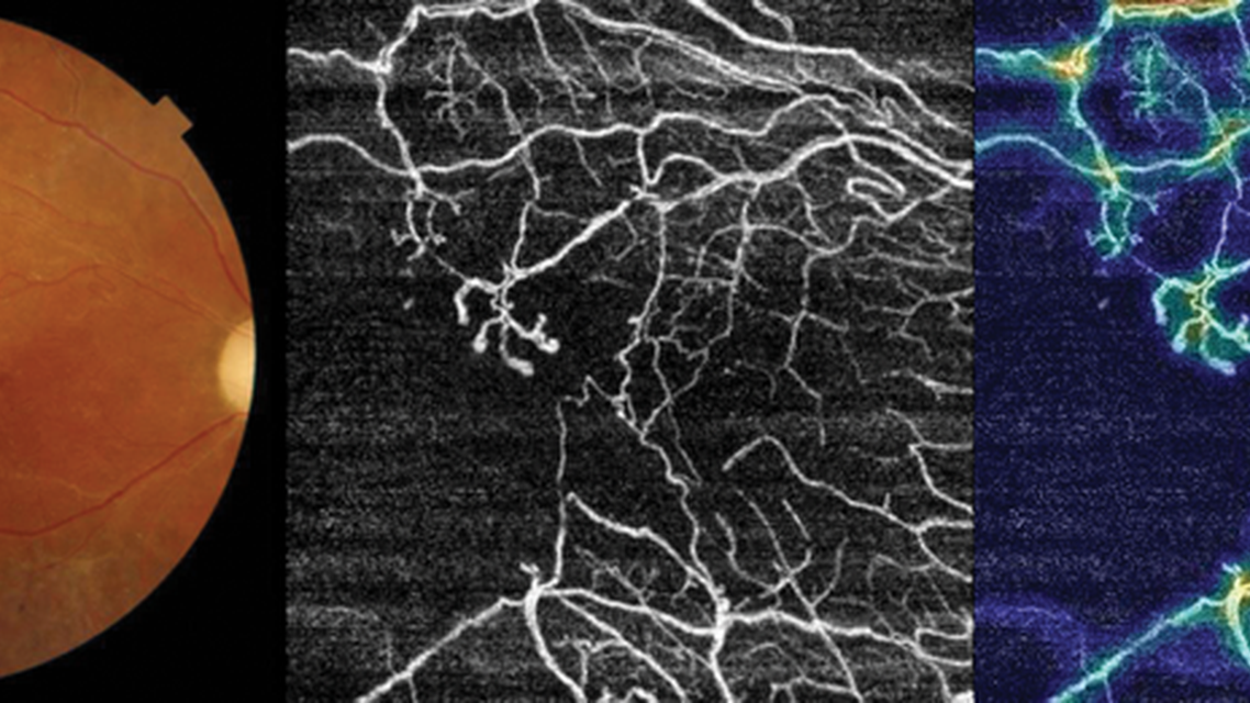 SS OCTA Proves Beneficial to Posterior Uveitis Management