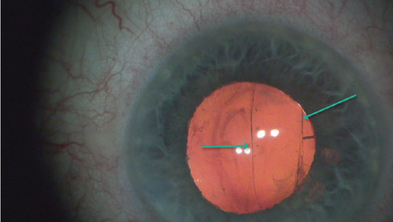 Rupture During Polishing of the Posterior Capsule
