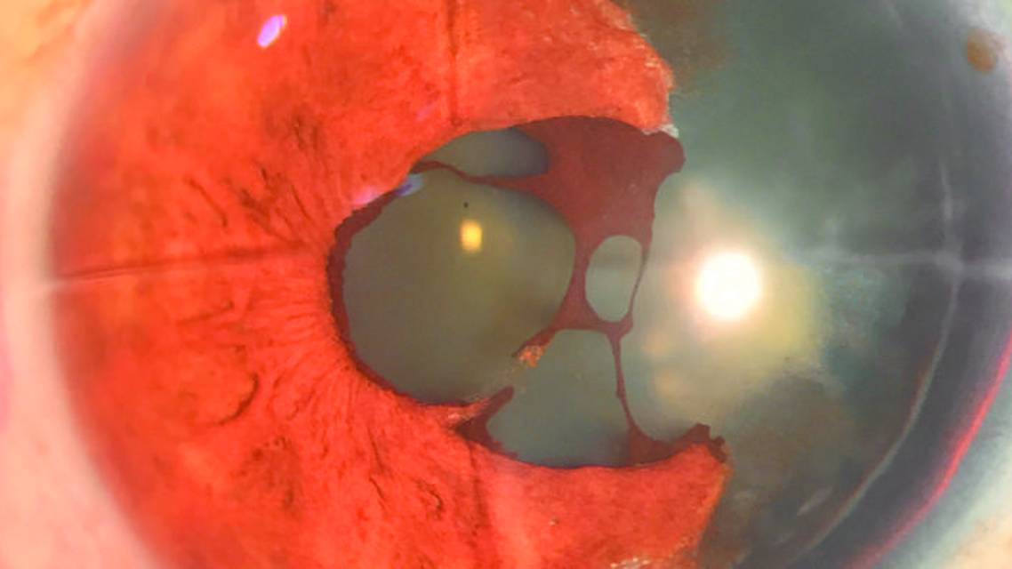 Traumatic Aniridia in a Patient With a History of Radial Keratotomy