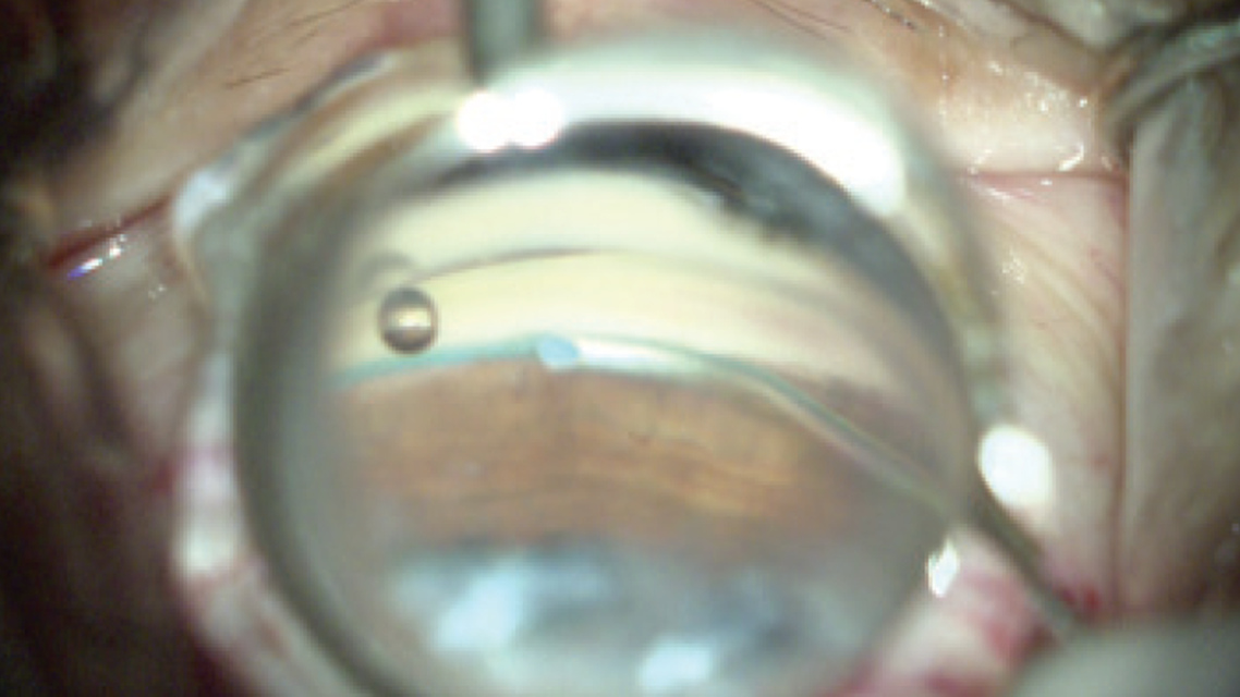 Spotlight on OMNI in Standalone Procedures