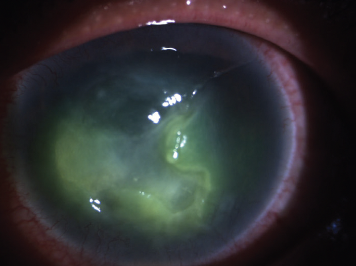 When the Eye Gets Meta Advanced Neurotrophic Keratopathy Secondary to Recurrent Herpes Simplex Keratitis