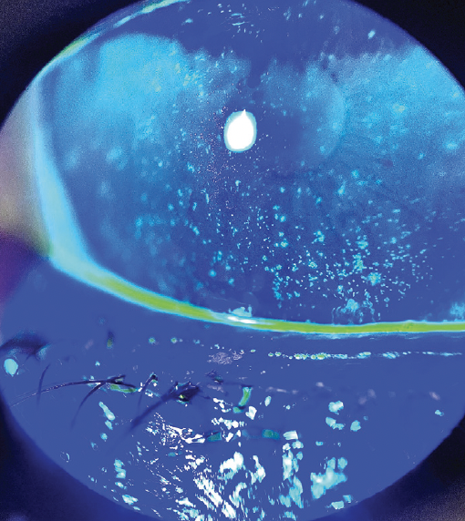Freeze Dried Amniotic Membrane for Filamentary Keratitis