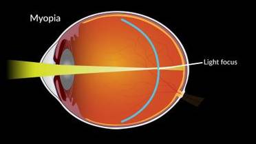 Study: Low-Dose Atropine Eye Drops No Better than Placebo for Slowing Myopia Progression image
