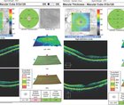 Epithelial Basement Membrane Dystrophy and Ocular Surface Disease