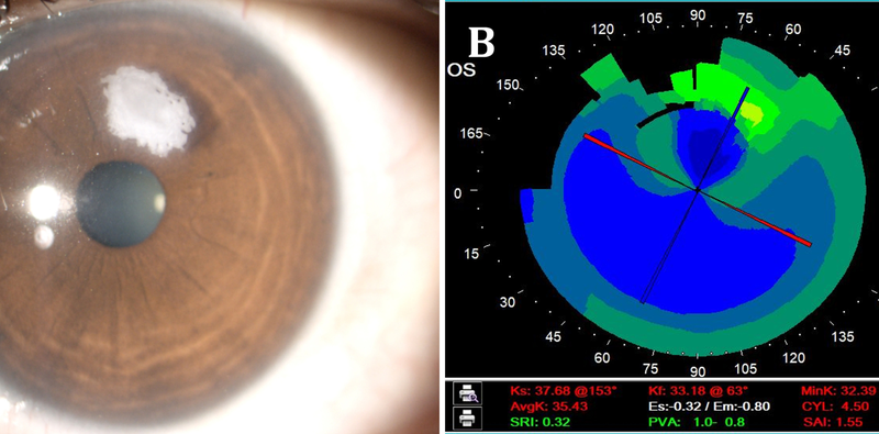 Epithelial Ingrowth After Laser Assisted Lenticule Extraction
