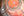 Figure 3. Nuclear remnants are removed from the eye.