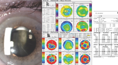 Comorbid Cataract and Macular Hole