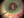 Figure 1. The needle is passed through cornea, mid-iris,
and the edge of the capsulorhexis, which is held with
microforceps.