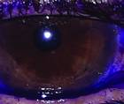 Dye Enhanced Laser Conjunctivoplasty for Conjunctivochalasis