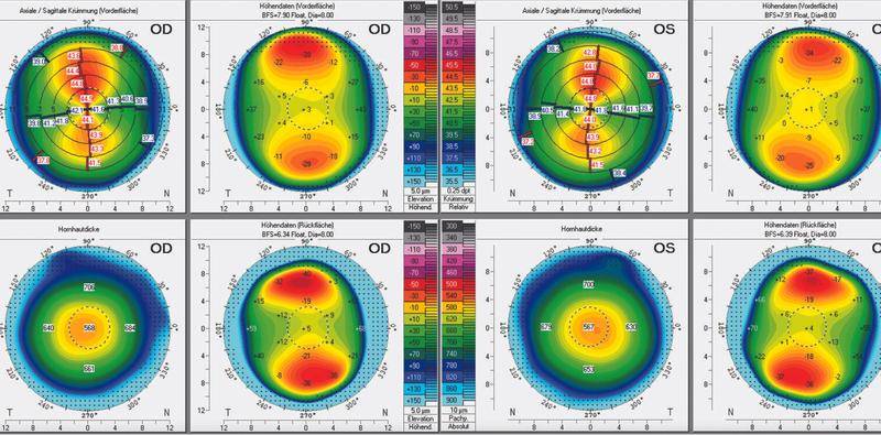 High Myopic Astigmatism