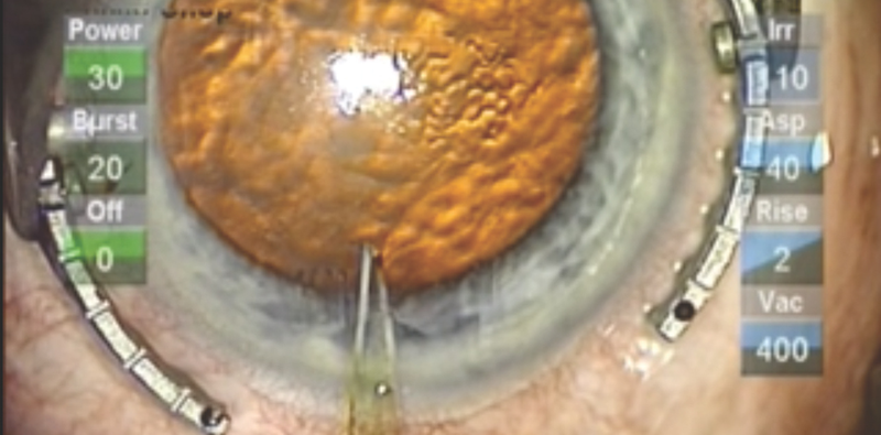 Optimizing the Incision