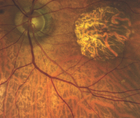 More Than 20 Radial Keratotomy Incisions