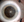 Figure. Dense brunescent cataract.