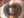 Figure 2. Patient with a calcified Akreos IOL referred to Dr. Safran for removal. This eye underwent PPV and trabeculectomy before calcification occurred. The patient’s UCVA improved from counting fingers to 20/30 after IOL exchange.