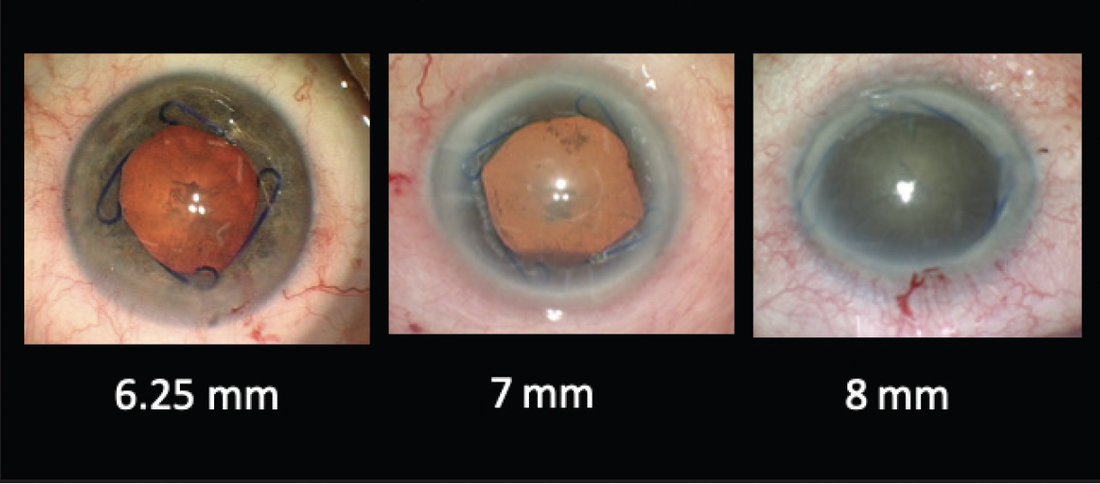 The Development and Impact of the Malyugin Ring
