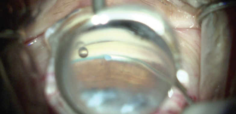 Spotlight on OMNI in Standalone Procedures