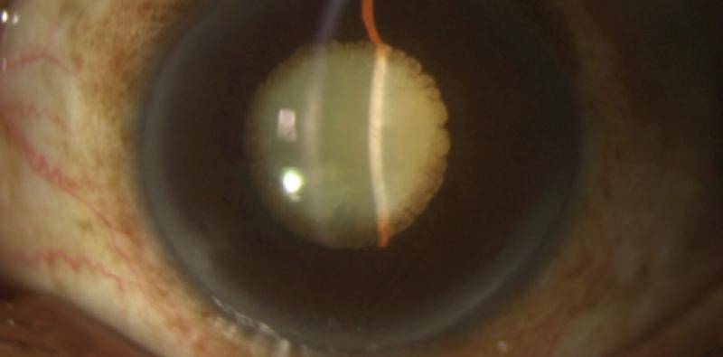 Refractive Myopia