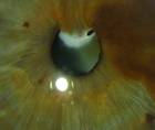 Congenital Cataract With Vascular Synechiae