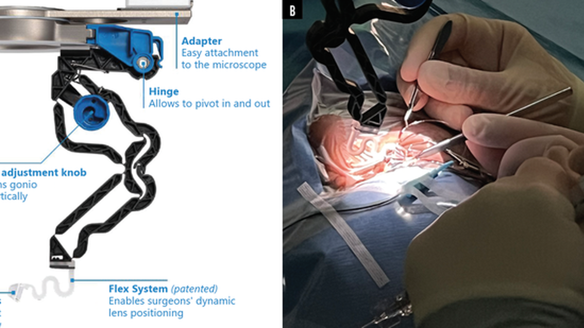 GONIO ready A New Gonioscopy System That Could Improve Your Surgical Approach With MIGS