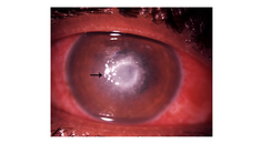 A Rare Case of Pythium Keratitis Masquerading as Fungal Keratitis