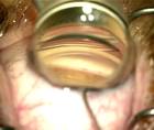 Combining Cataract and Glaucoma Surgery thumbnail