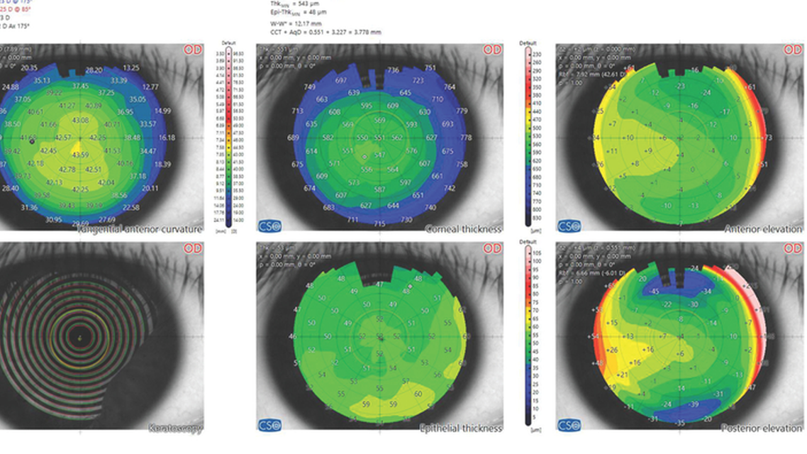 Extreme Myopia