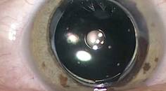 Off Label Use of Femtosecond Laser for Posterior Capsulotomy
