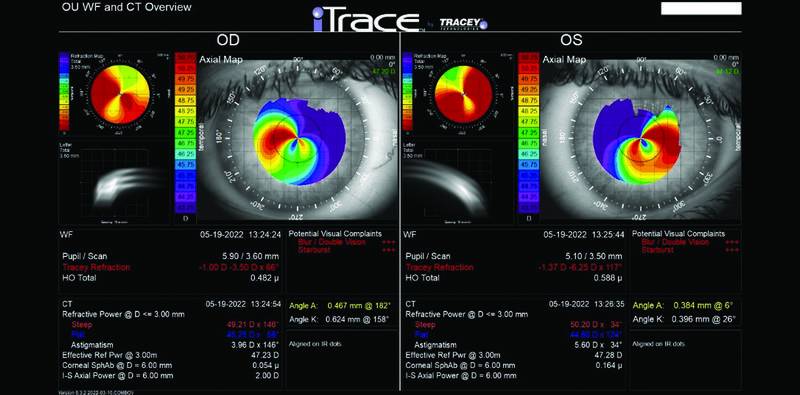Contact Lens Intolerance After CXL