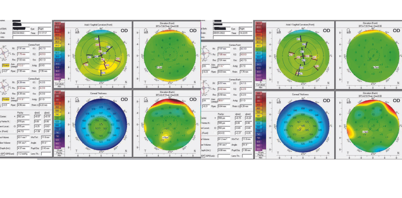 Persistently Blurred Vision After LASIK