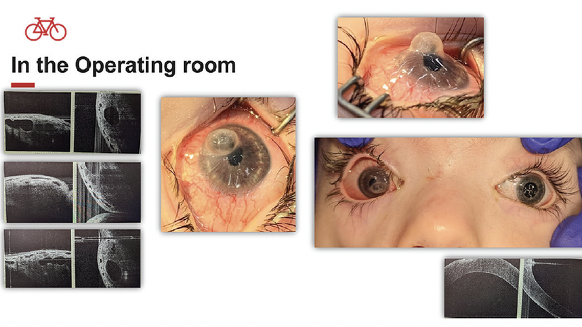 A Unique Case of Moraxella Keratitis in Moebius Syndrome