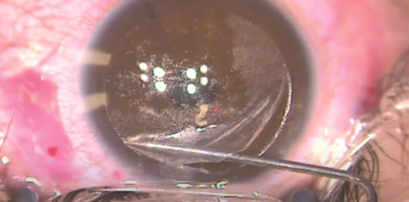 Management of a Flap Hinge Tear