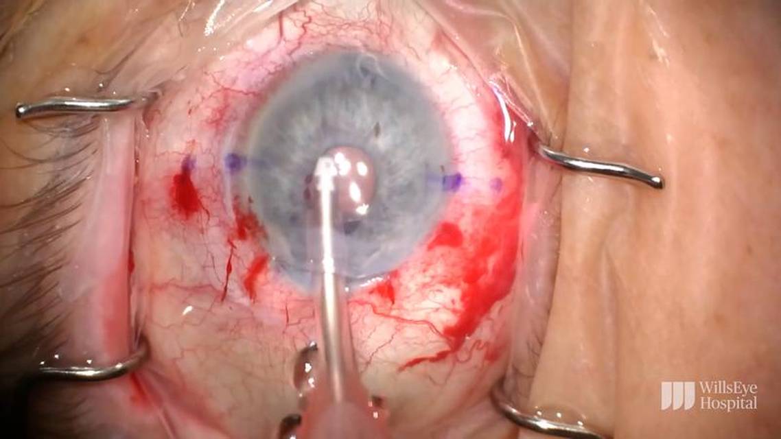 Corneal Edema in the Context of an Anterior Chamber IOL thumbnail