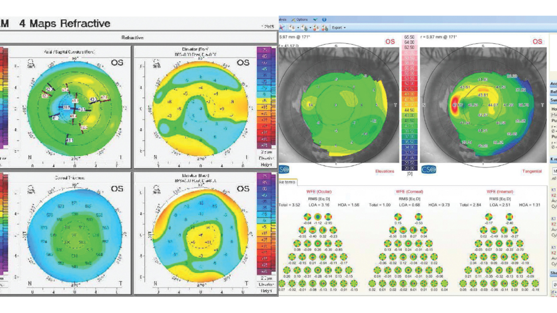 Monocular Diplopia Foggy Vision and Uncomfortable Binocular Vision