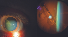 Traumatic Cataract Secondary to Needle Puncture for Intravitreal Injection