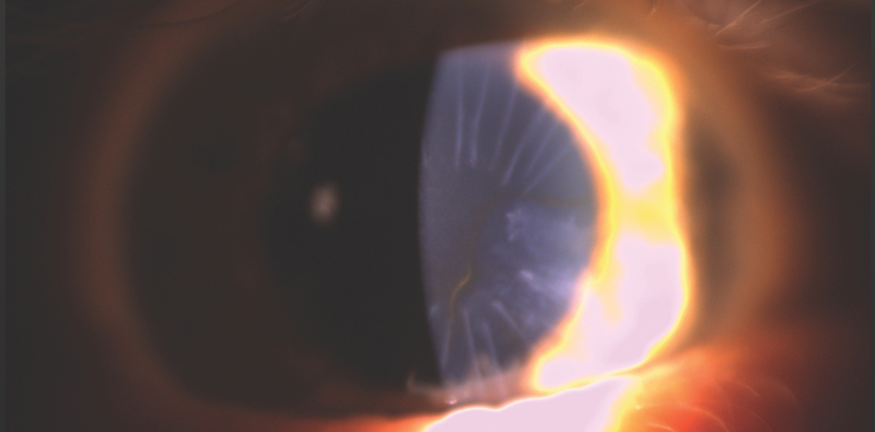 A Patient With Dry AMD Desires Improved Vision