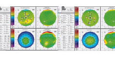 Persistently Blurred Vision After LASIK