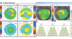Monocular Diplopia Foggy Vision and Uncomfortable Binocular Vision