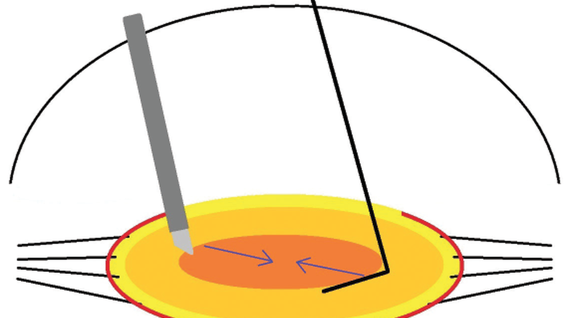 Zonulopathy and the Dense Cataract